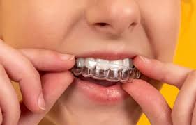 aligner dental clinic sola braces