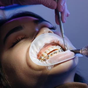 braces dental clinic sola metal