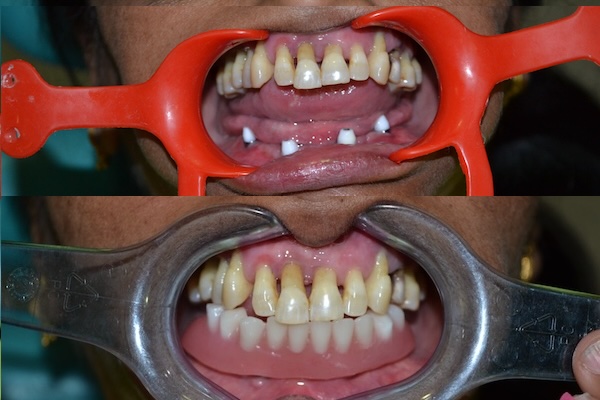 Rootcanal dental clinic near me sciencecity